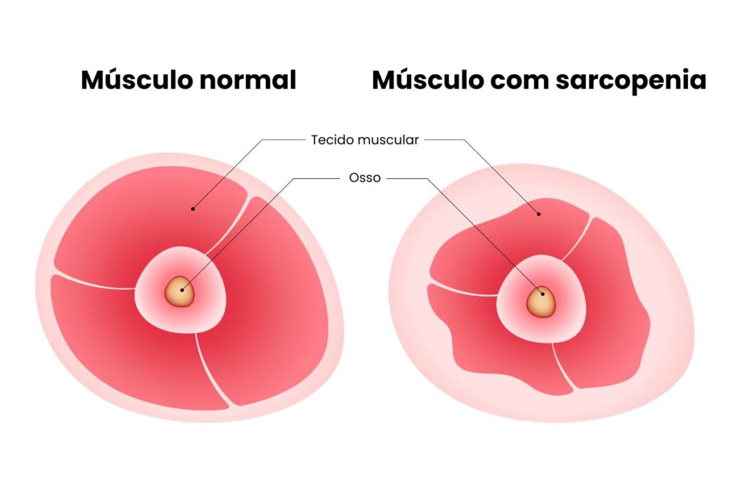 Músculo Sormal X Músculo com Sarcopenia